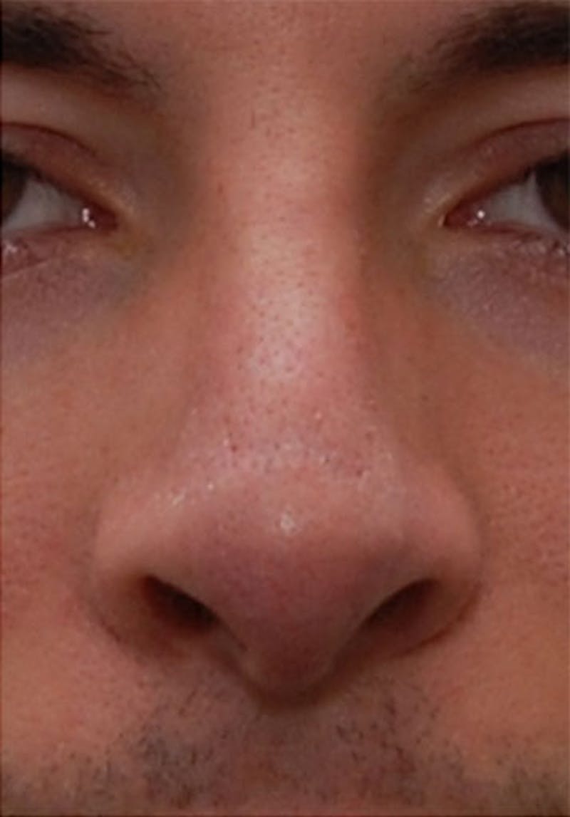 Non-Surgical Rhinoplasty Before & After Gallery - Patient 251185 - Image 2