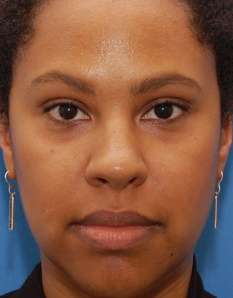 Foundation Rhinoplasty / Crooked Nose Before & After Gallery - Patient 195518 - Image 2