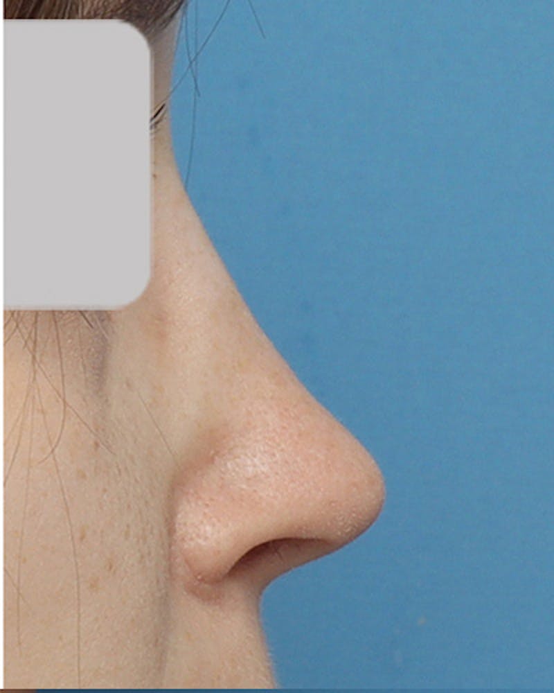 Rhinoplasty Before & After Gallery - Patient 363555 - Image 2