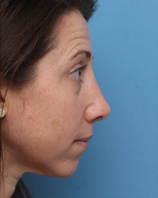 Rhinoplasty Before & After Gallery - Patient 358221 - Image 4