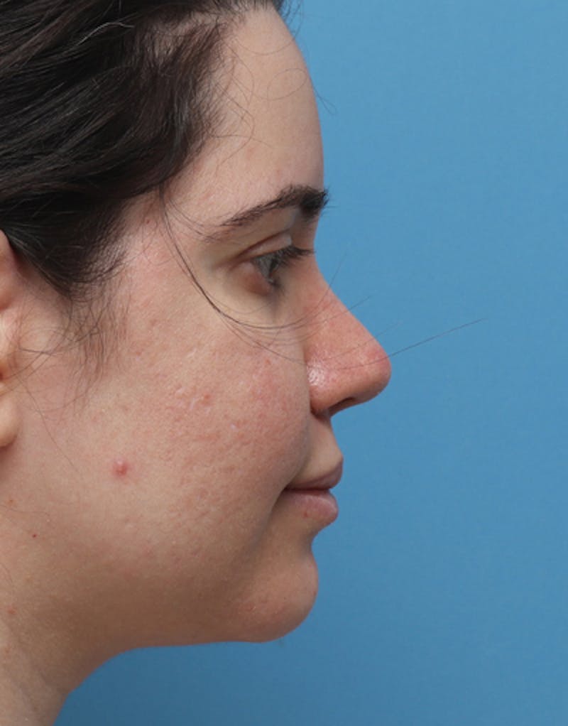 Ethnic Rhinoplasty Before & After Gallery - Patient 147895 - Image 2