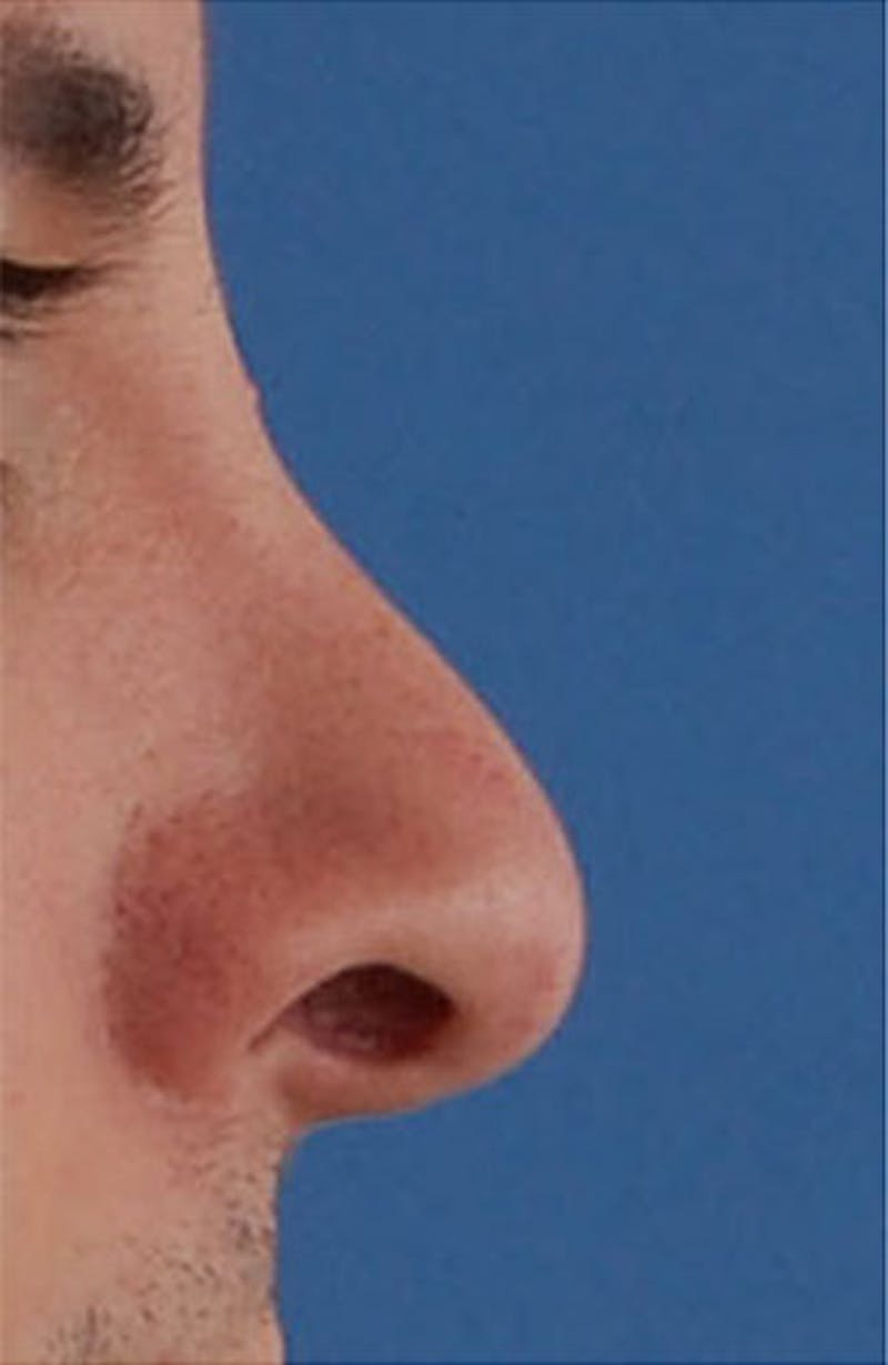 Non-Surgical Rhinoplasty Before & After Gallery - Patient 251185 - Image 3