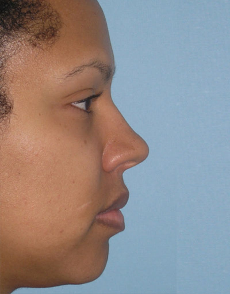 Foundation Rhinoplasty / Crooked Nose Before & After Gallery - Patient 195518 - Image 3