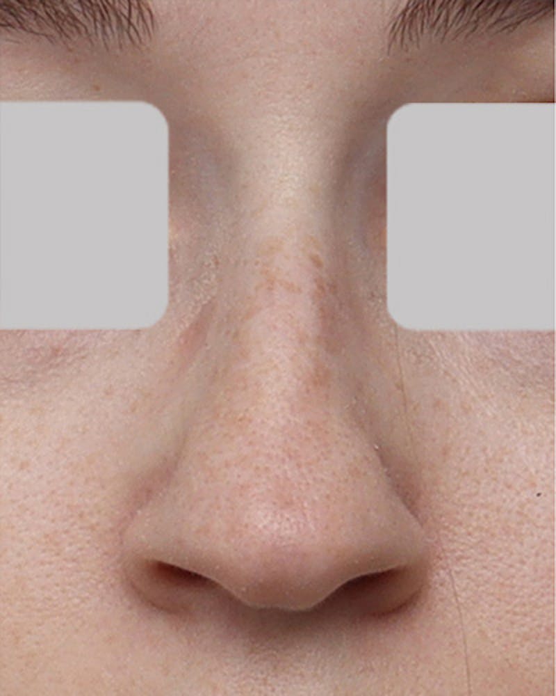 Rhinoplasty Before & After Gallery - Patient 363555 - Image 3