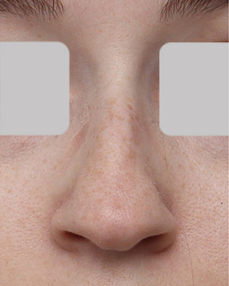 Rhinoplasty  Before & After Gallery - Patient 427341 - Image 3