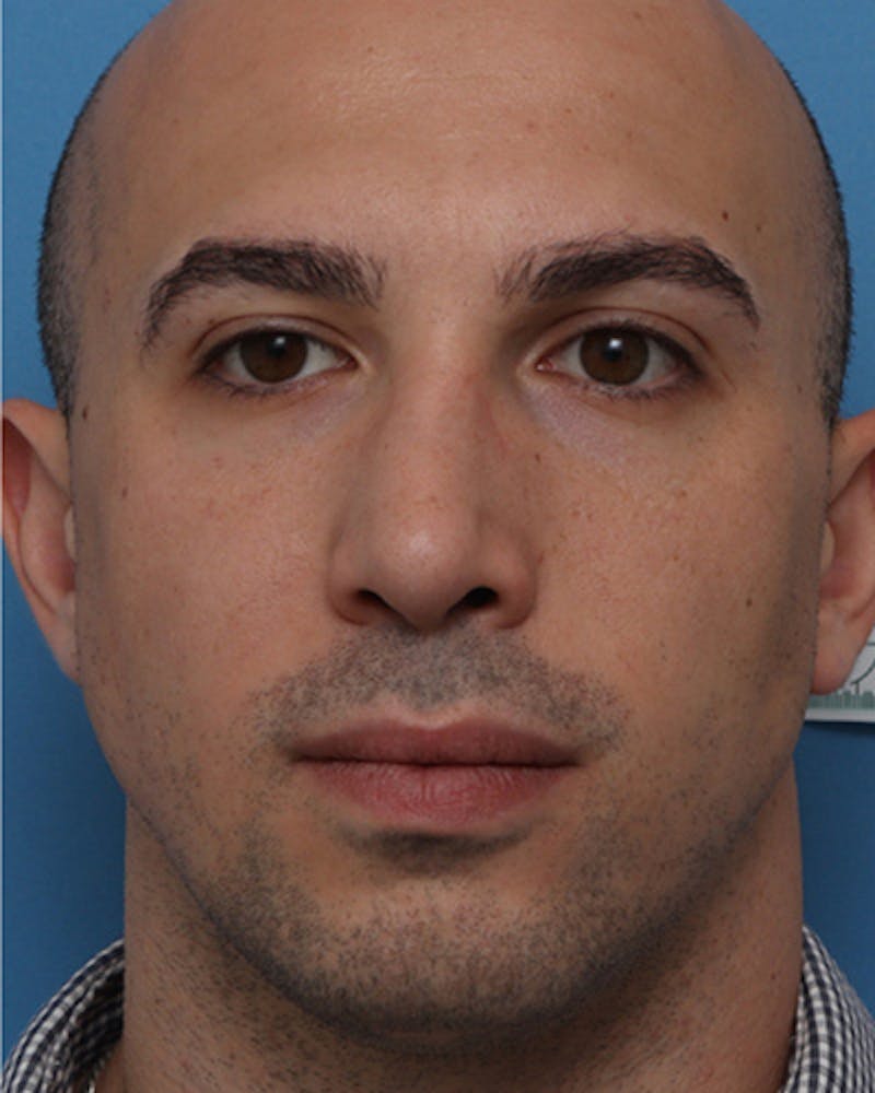 Male Rhinoplasty Before & After Gallery - Patient 908208 - Image 4