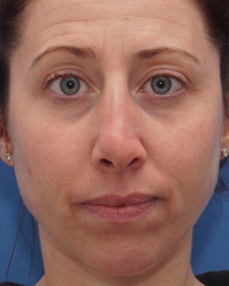 Revision Rhinoplasty Before & After Gallery - Patient 573914 - Image 3
