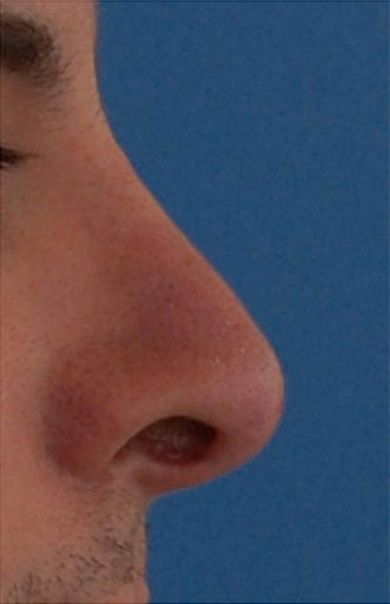 Non-Surgical Rhinoplasty Before & After Gallery - Patient 251185 - Image 4