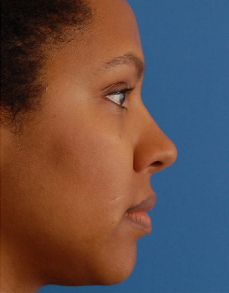 Foundation Rhinoplasty / Crooked Nose Before & After Gallery - Patient 195518 - Image 4