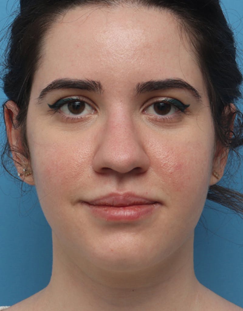 Ethnic Rhinoplasty Before & After Gallery - Patient 147895 - Image 3