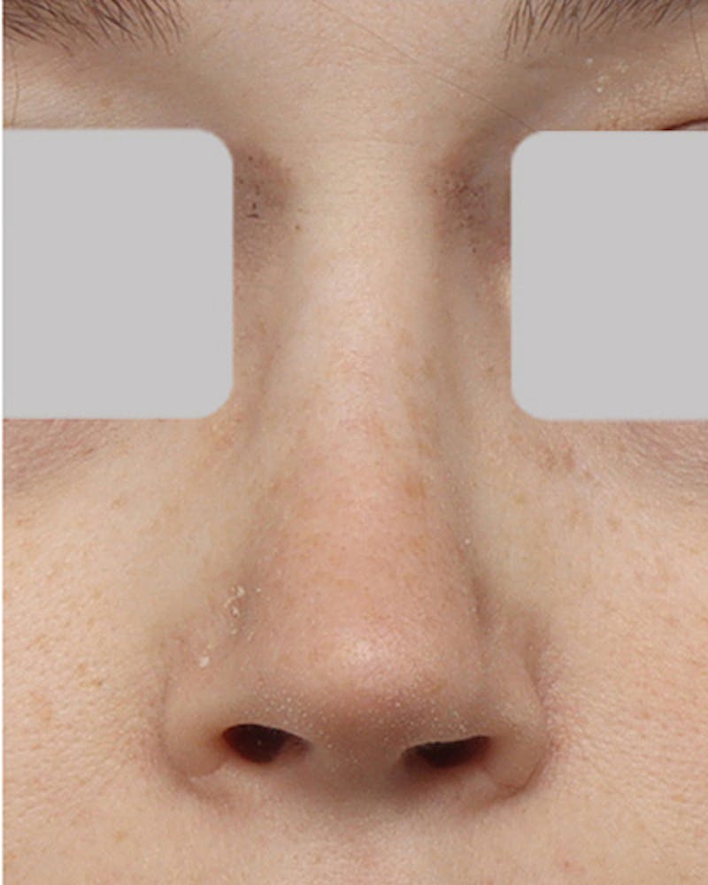 Rhinoplasty Before & After Gallery - Patient 363555 - Image 4