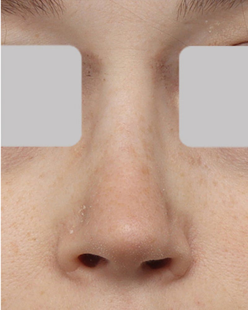 Rhinoplasty  Before & After Gallery - Patient 427341 - Image 4
