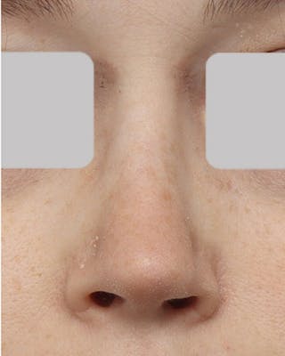 Rhinoplasty Before & After Gallery - Patient 427341 - Image 4