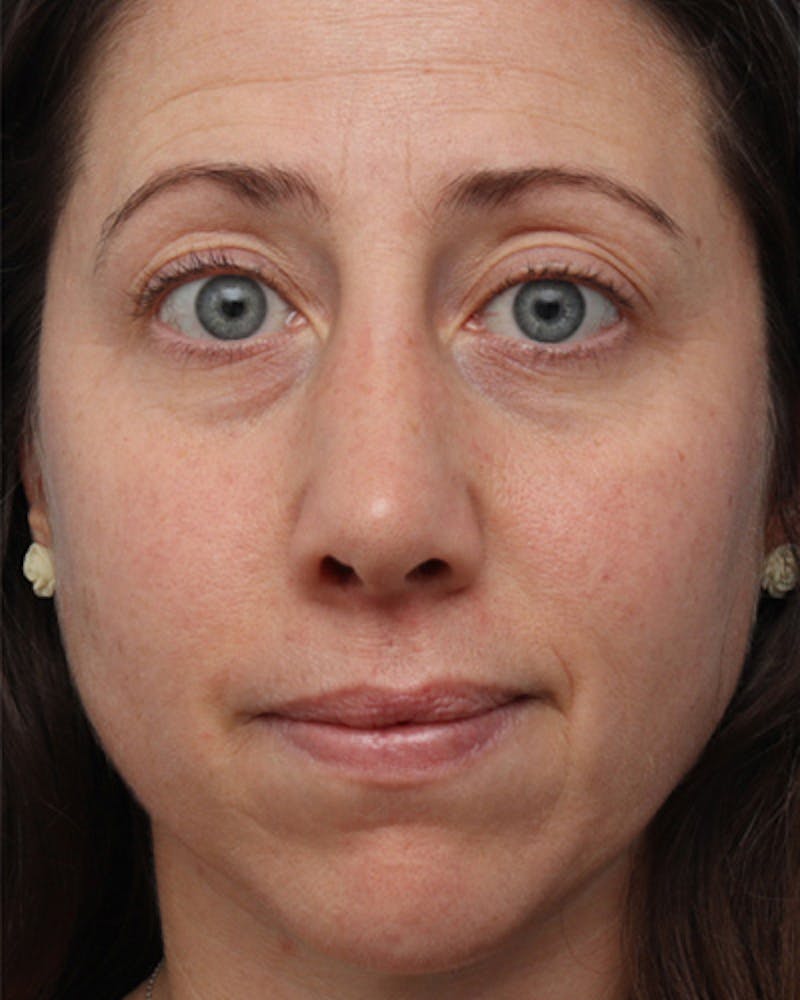 Revision Rhinoplasty Before & After Gallery - Patient 573914 - Image 4