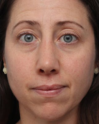 Rhinoplasty Before & After Gallery - Patient 358221 - Image 6