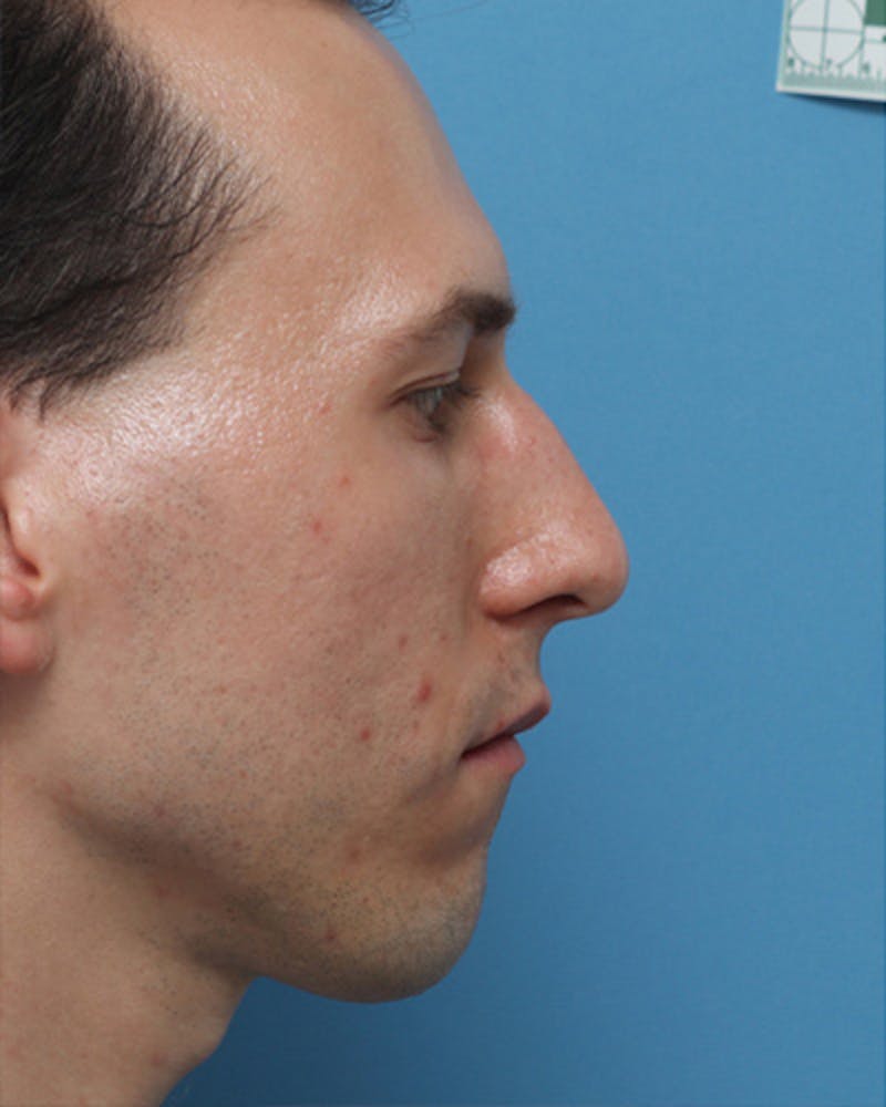 Patient Bhk_VROQTmasYxze7cmNuQ - Male Rhinoplasty Before & After Photos