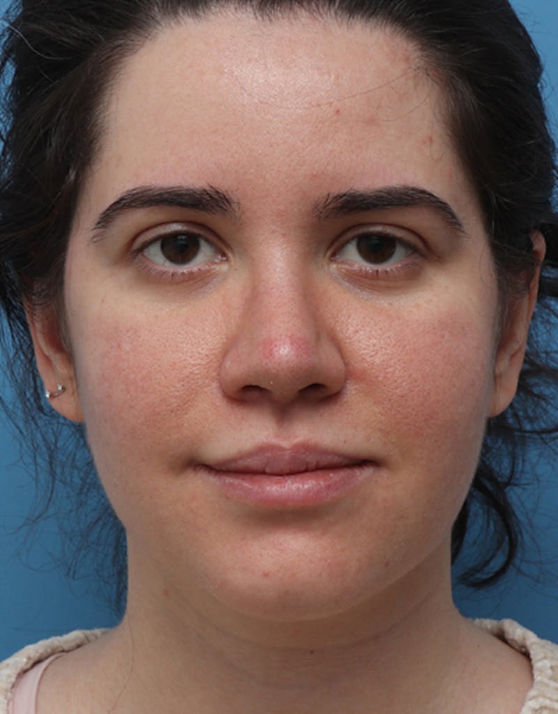 Ethnic Rhinoplasty Before & After Gallery - Patient 147895 - Image 4