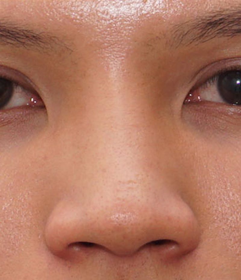 Non-Surgical Rhinoplasty Before & After Gallery - Patient 173592 - Image 3