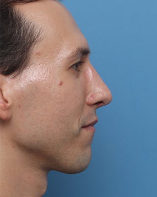 Favorite Male Rhinoplasty Before & After Gallery - Patient 212398 - Image 2