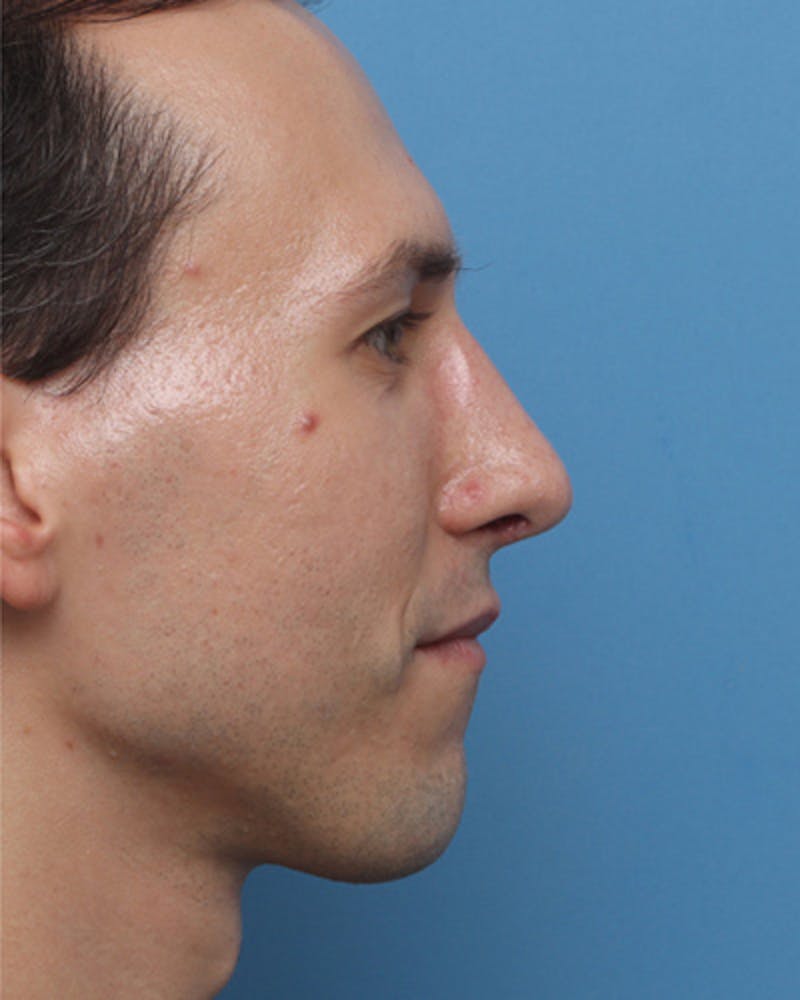 Male Rhinoplasty Before & After Gallery - Patient 393286 - Image 2