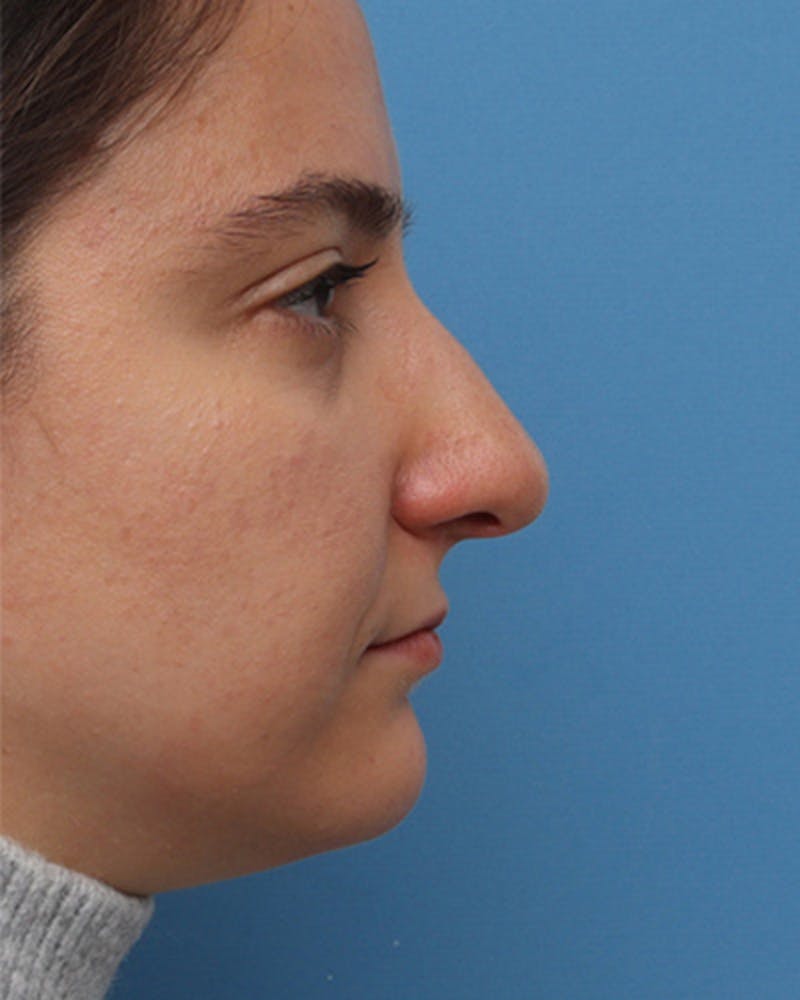 Patient AUFJPwWtQM2mz-U3KMir-w - Rhinoplasty Before & After Photos