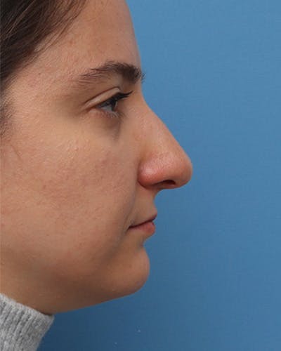 Rhinoplasty Before & After Gallery - Patient 258423 - Image 1