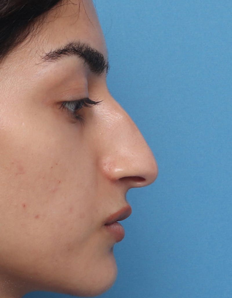Ethnic Rhinoplasty Before & After Gallery - Patient 303425 - Image 1