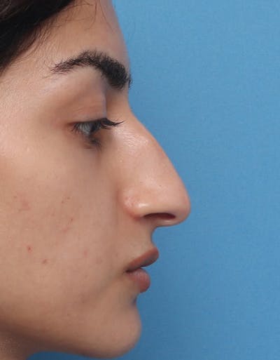 Rhinoplasty Before & After Gallery - Patient 160462 - Image 1