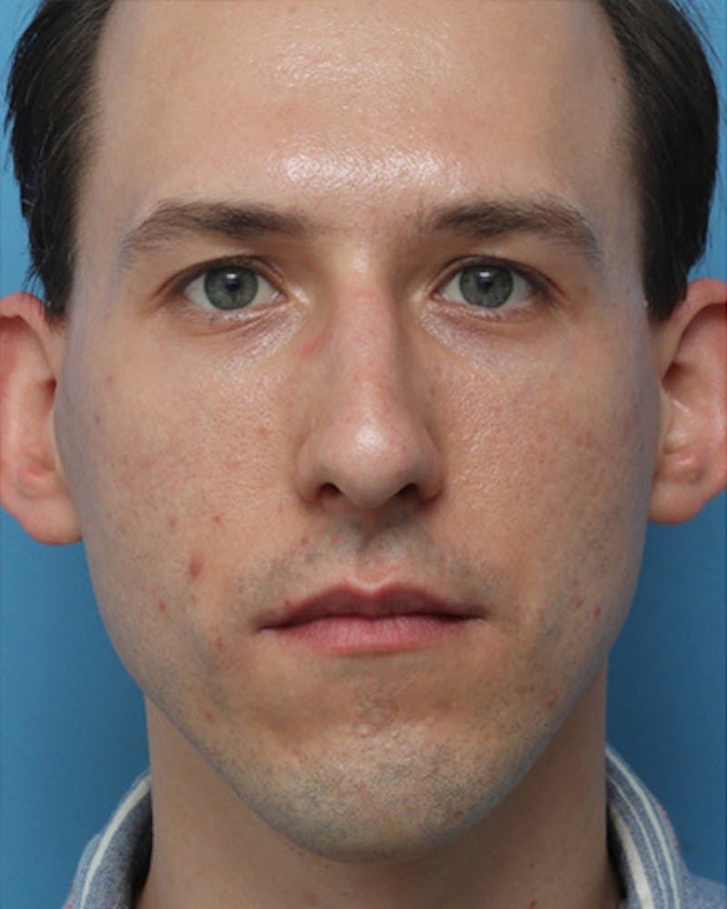 Male Rhinoplasty Before & After Gallery - Patient 393286 - Image 3