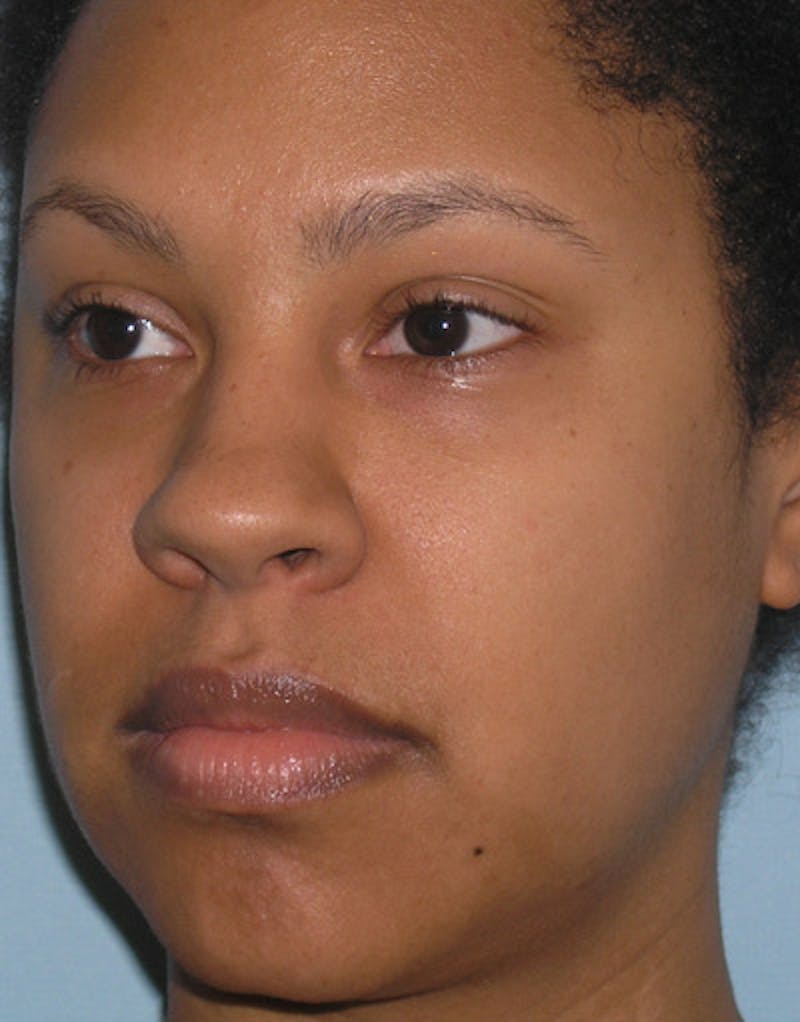 Foundation Rhinoplasty / Crooked Nose Before & After Gallery - Patient 195518 - Image 7