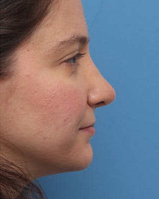 Rhinoplasty Before & After Gallery - Patient 258423 - Image 2