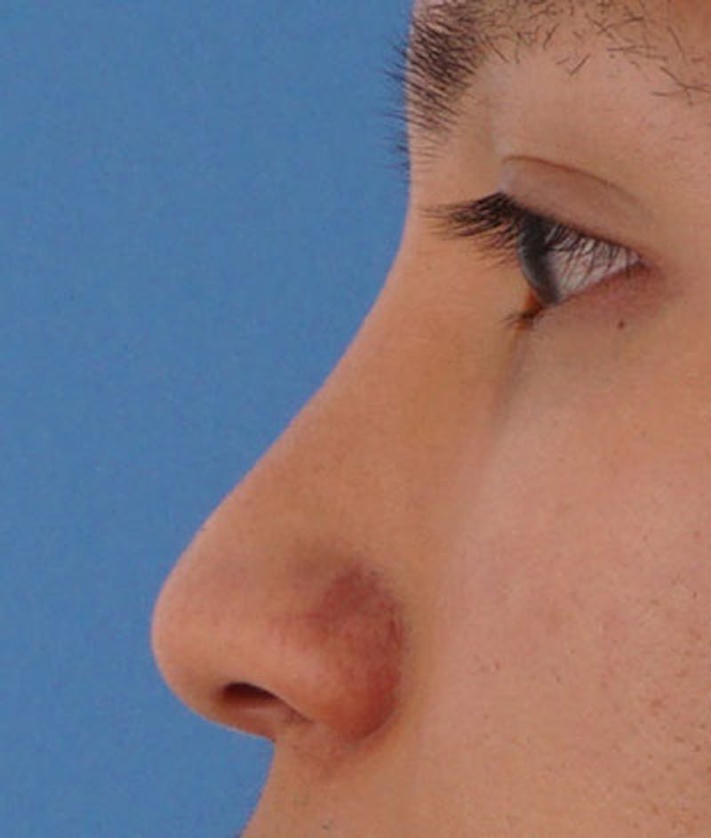 Patient SDWdj5iZRgKzYF3bSyb2fQ - Non-Surgical Rhinoplasty Before & After Photos