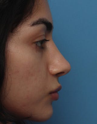 Rhinoplasty Before & After Gallery - Patient 160462 - Image 2