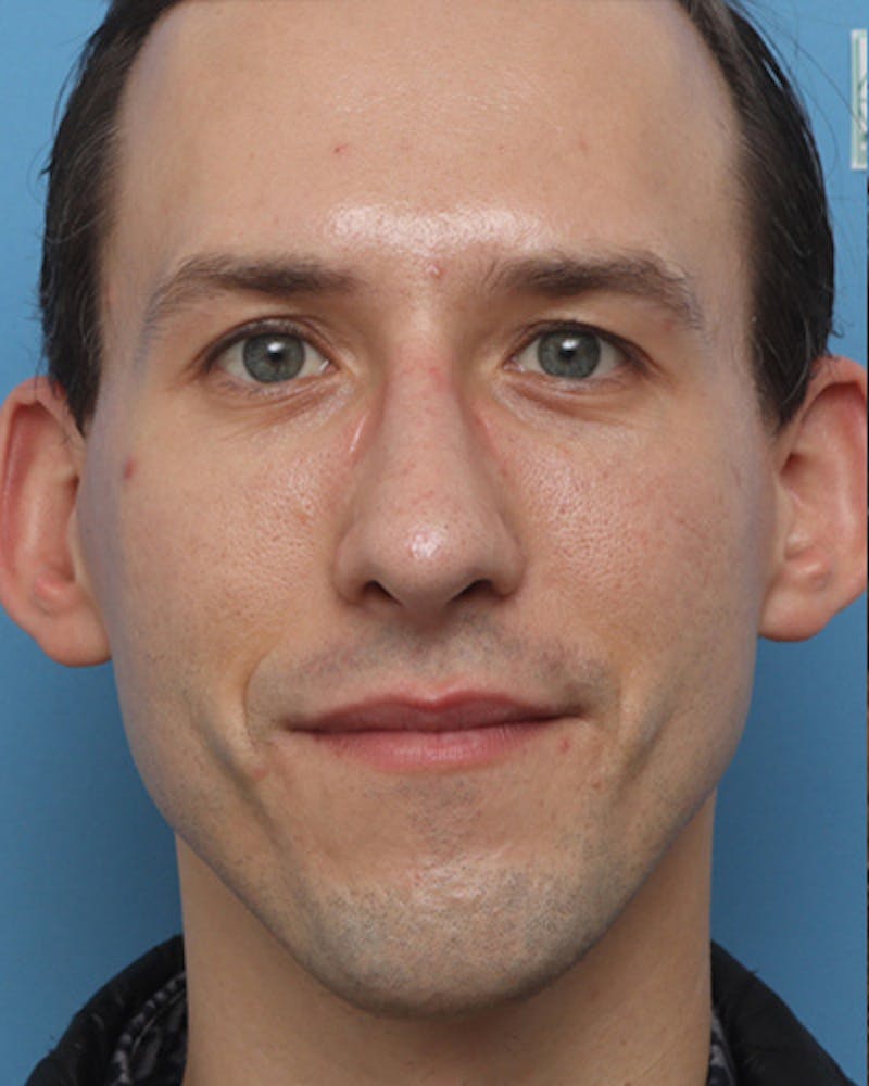 Male Rhinoplasty Before & After Gallery - Patient 393286 - Image 4