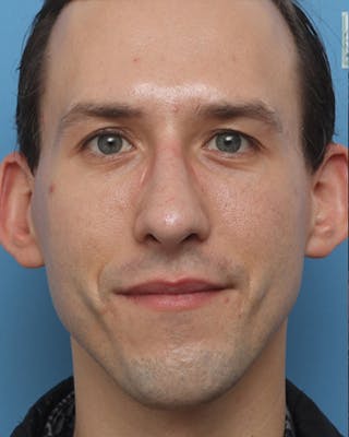 Favorite Male Rhinoplasty Before & After Gallery - Patient 212398 - Image 4