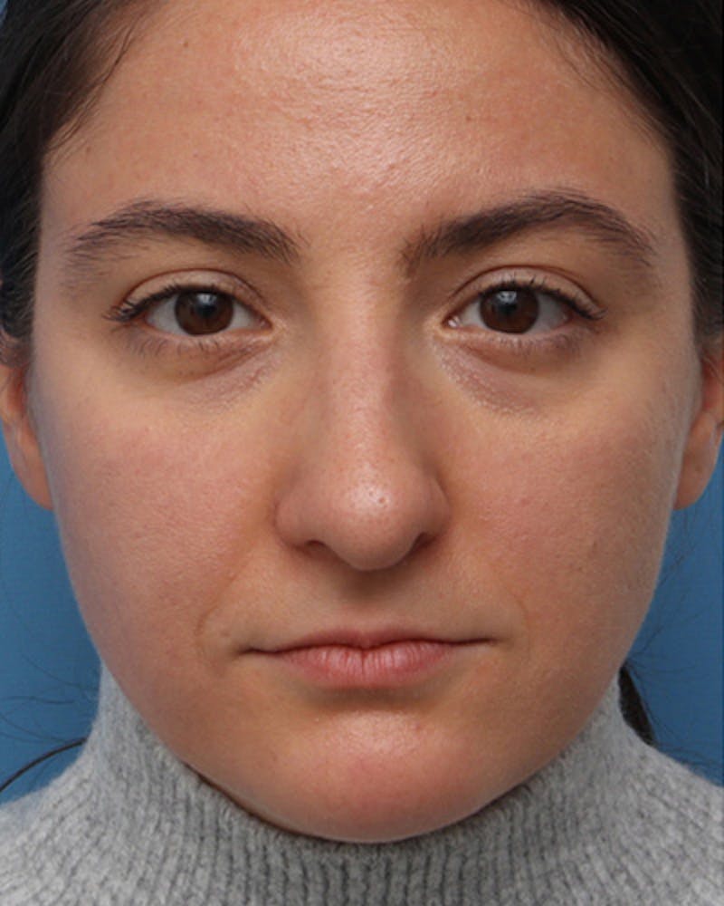 Rhinoplasty  Before & After Gallery - Patient 258423 - Image 3