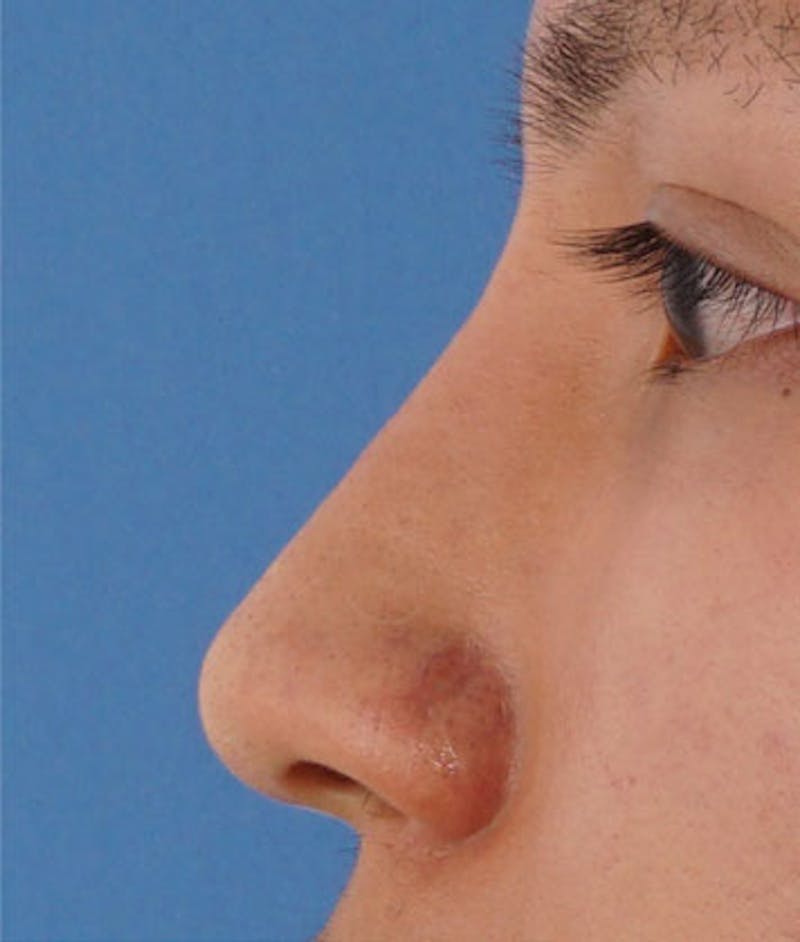 Non-Surgical Rhinoplasty Before & After Gallery - Patient 173592 - Image 2