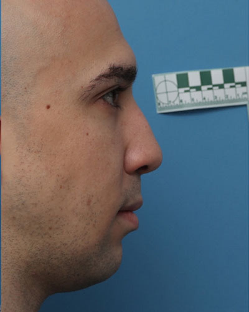 Revision Rhinoplasty Before & After Gallery - Patient 287003 - Image 1