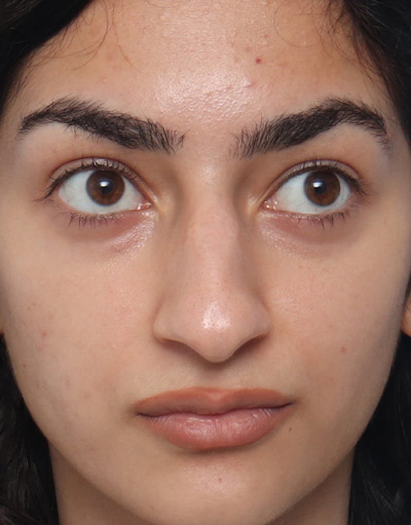 Ethnic Rhinoplasty Before & After Gallery - Patient 303425 - Image 3