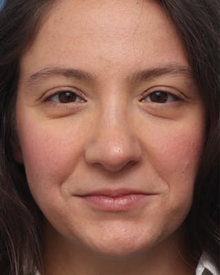 Rhinoplasty Before & After Gallery - Patient 258423 - Image 4