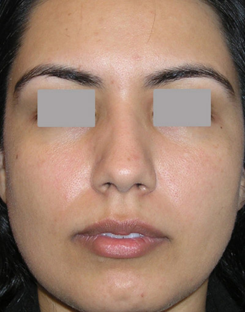 Foundation Rhinoplasty / Crooked Nose Before & After Gallery - Patient 278075 - Image 1