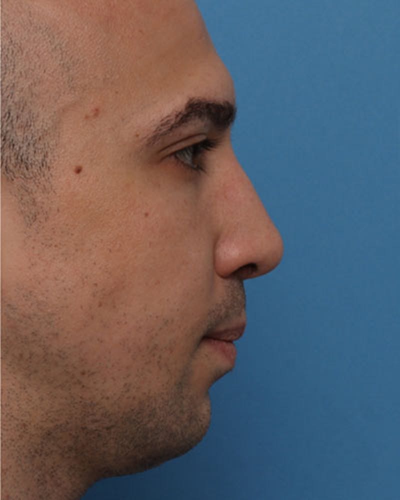 Revision Rhinoplasty Before & After Gallery - Patient 287003 - Image 2