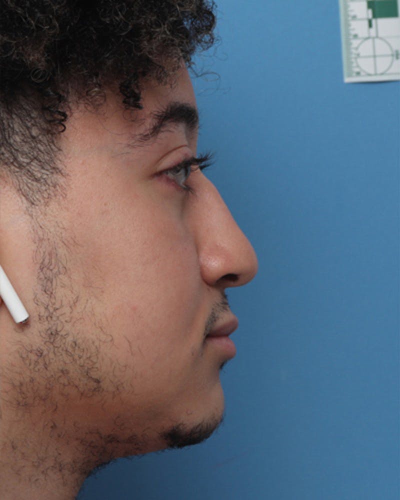 Male Rhinoplasty Before & After Gallery - Patient 346574 - Image 1