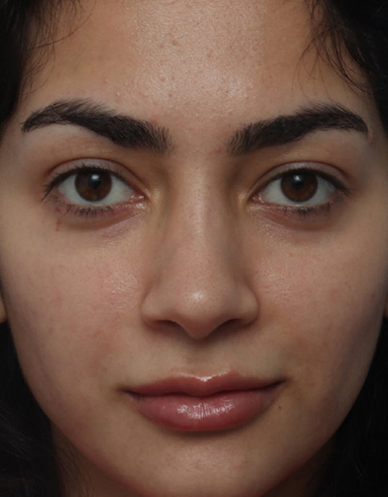 Ethnic Rhinoplasty Before & After Gallery - Patient 303425 - Image 4