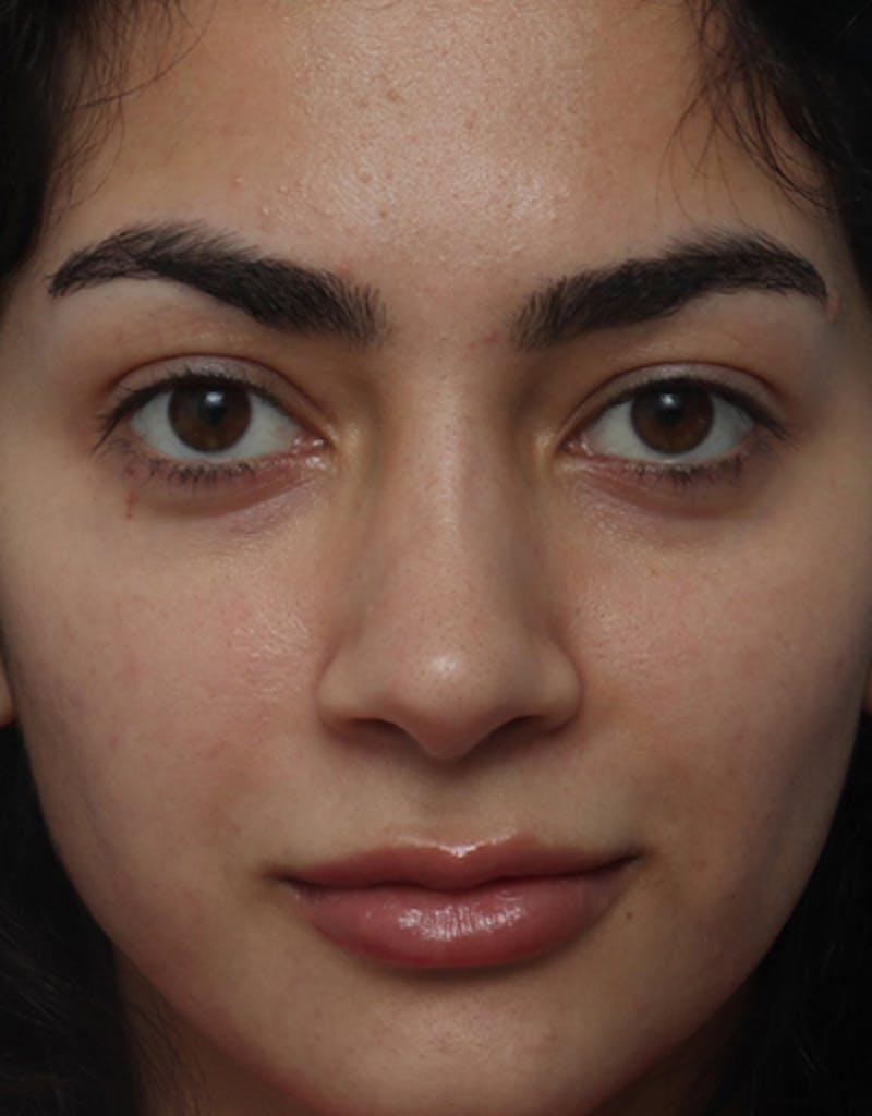 Rhinoplasty  Before & After Gallery - Patient 160462 - Image 4