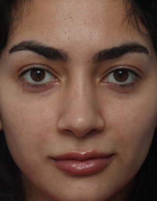Rhinoplasty Before & After Gallery - Patient 160462 - Image 4