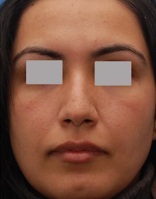 Favorite Foundation Rhinoplasty / Crooked Nose Before & After Gallery - Patient 240227 - Image 2