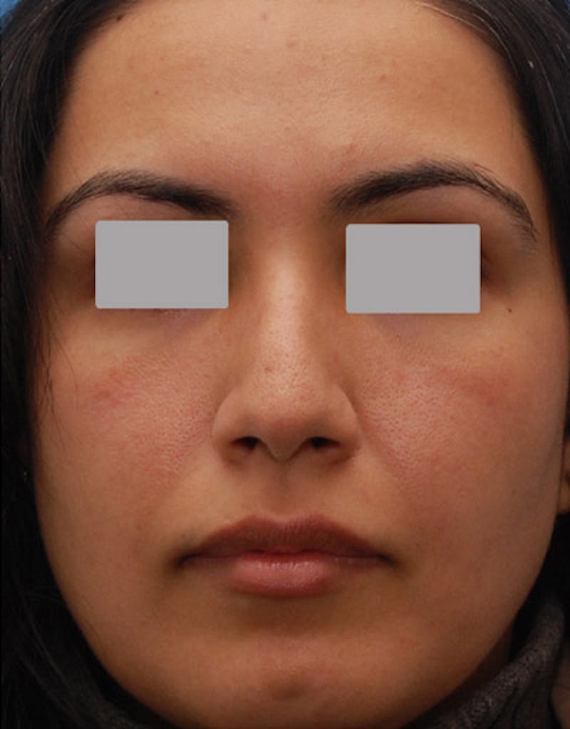 Foundation Rhinoplasty / Crooked Nose Before & After Gallery - Patient 278075 - Image 2