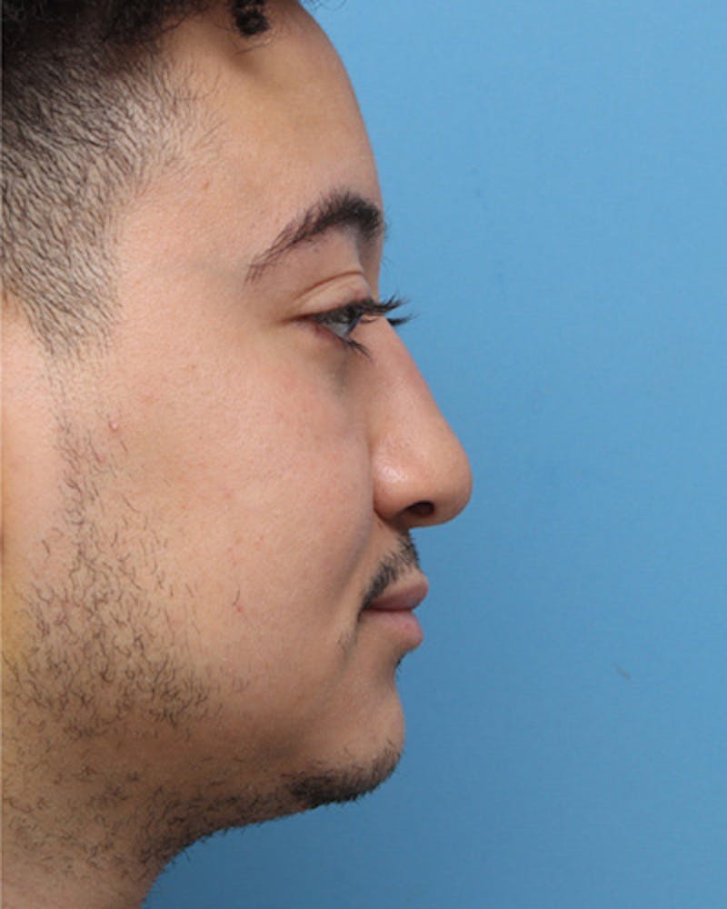 Male Rhinoplasty Before & After Gallery - Patient 346574 - Image 2