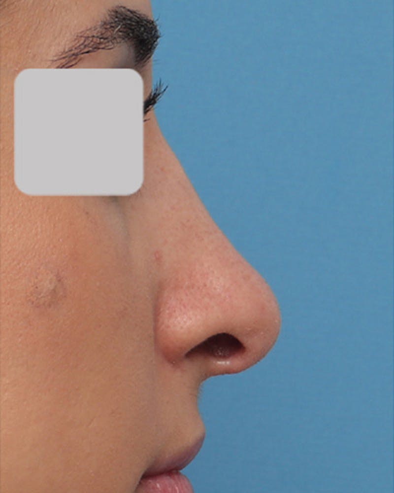 Rhinoplasty Before & After Gallery - Patient 799614 - Image 1